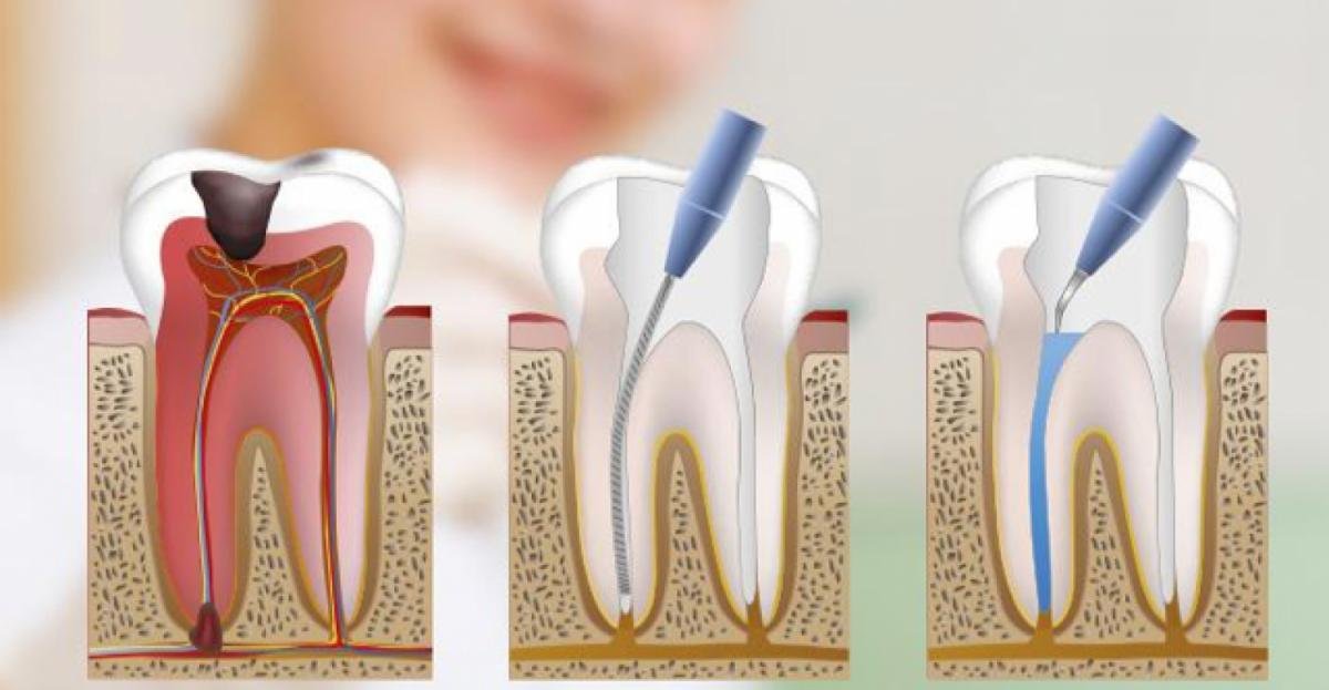 Relief from tooth pain